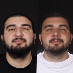Erkek-Rinoplasti-5-3-300x300