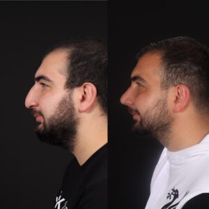 Erkek-Rinoplasti-5-300x300