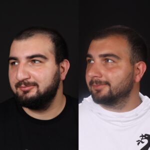 Erkek-Rinoplasti-5-4-300x300