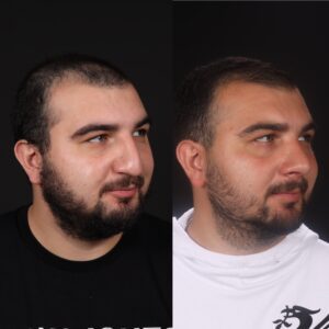 Erkek-Rinoplasti-5-5-300x300