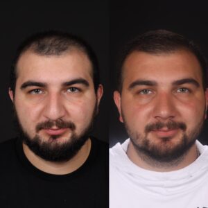 Erkek-Rinoplasti-5-6-300x300