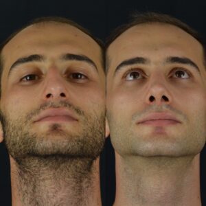 Erkek-Rinoplasti-8-300x300
