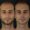 Erkek-Rinoplasti-8-5-300x300