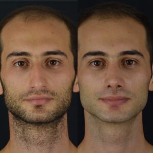 Erkek-Rinoplasti-8-5-300x300