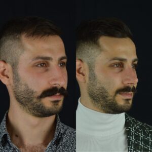 Erkek-burun-estetigi-1-3-300x300