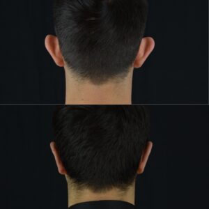 Kepce-kulak-1-2-300x300