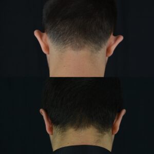 Kepce-kulak-1-3-300x300