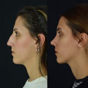 Rinoplasti-10-birlestirilmis-hali-2-300x300