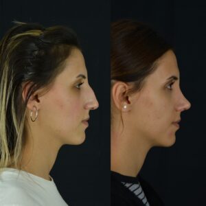 Rinoplasti-10-birlestirilmis-hali-3-300x300