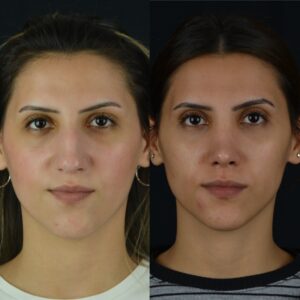 Rinoplasti-10-birlestirilmis-hali--300x300