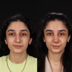Rinoplasti-13-2-300x300