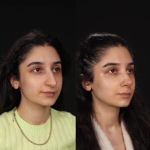 Rinoplasti-13-3-300x300