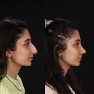 Rinoplasti-13-5-300x300