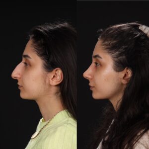 Rinoplasti-13-7-300x300