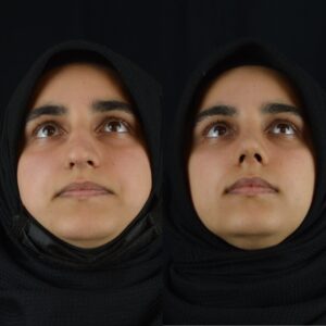 Rinoplasti-3-2-300x300