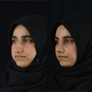 Rinoplasti-3-3-300x300