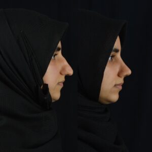 Rinoplasti-3-300x300