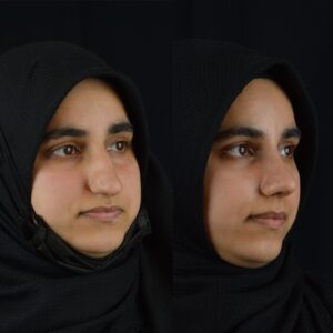Rinoplasti-3-5-300x300