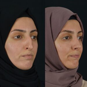 Rinoplasti-7-2-300x300