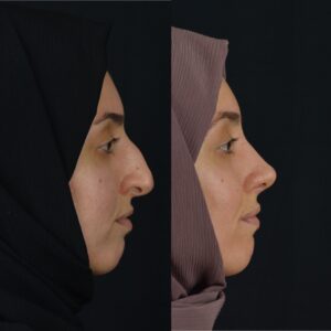 Rinoplasti-7-300x300