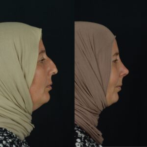 Rinoplasti-8-2-300x300