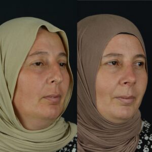 Rinoplasti-8-3-300x300