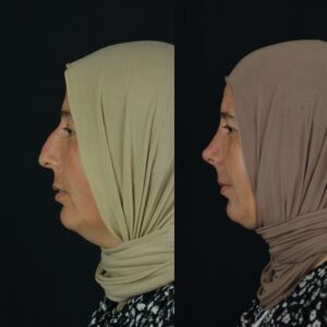 Rinoplasti-8-300x300