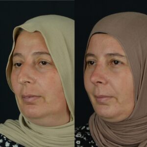 Rinoplasti-8-4-300x300
