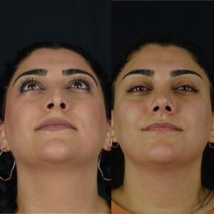 Rinoplasti-9-2-300x300