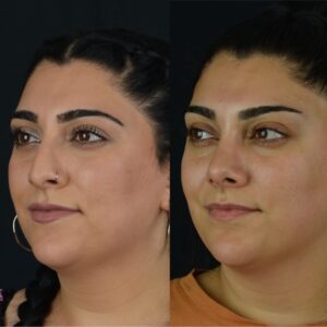 Rinoplasti-9-3-300x300