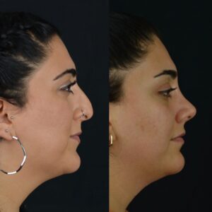 Rinoplasti-9-300x300