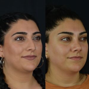Rinoplasti-9-4-300x300