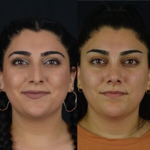 Rinoplasti-9-5-300x300
