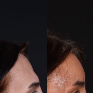 Yuz-Feminizasyonu-1-300x300