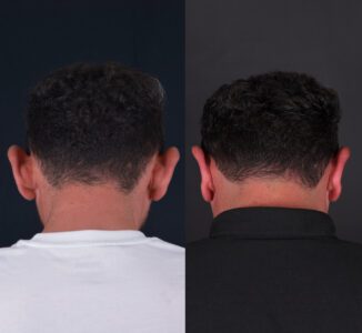 otoplasty-before-after (1)