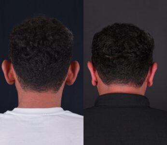 otoplasty-before-after (2)