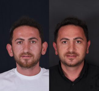 otoplasty-istanbul