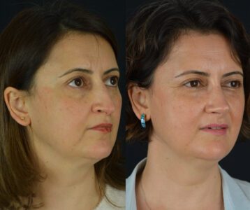 yeni-1-3-358x300