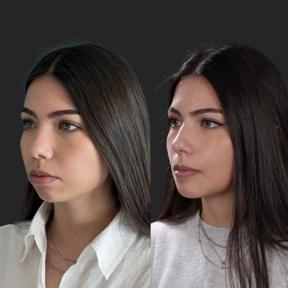 #1 (1) Facial Implants, 22 y.o., 8 days