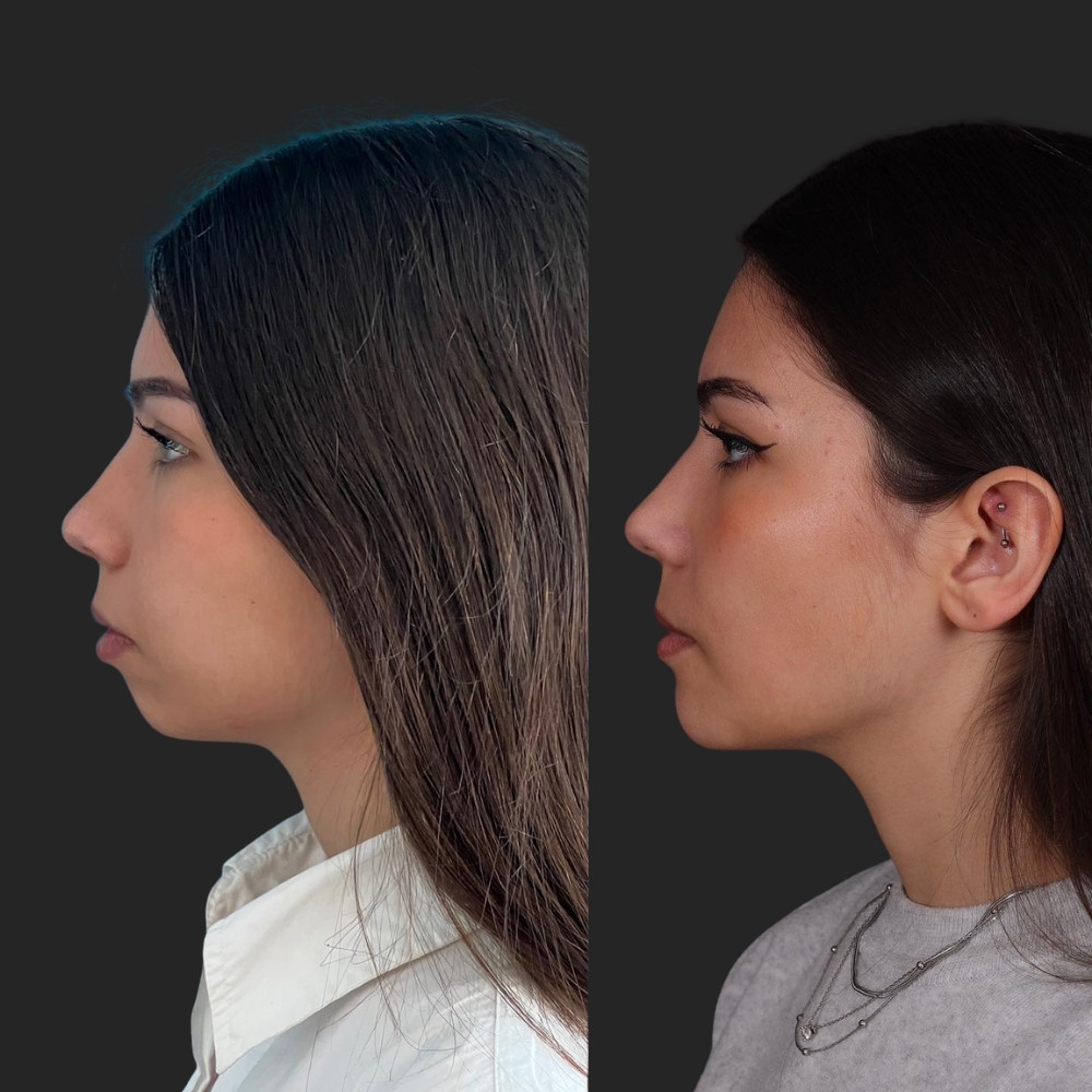 #1 (2) Facial Implants, 22 y.o., 8 days