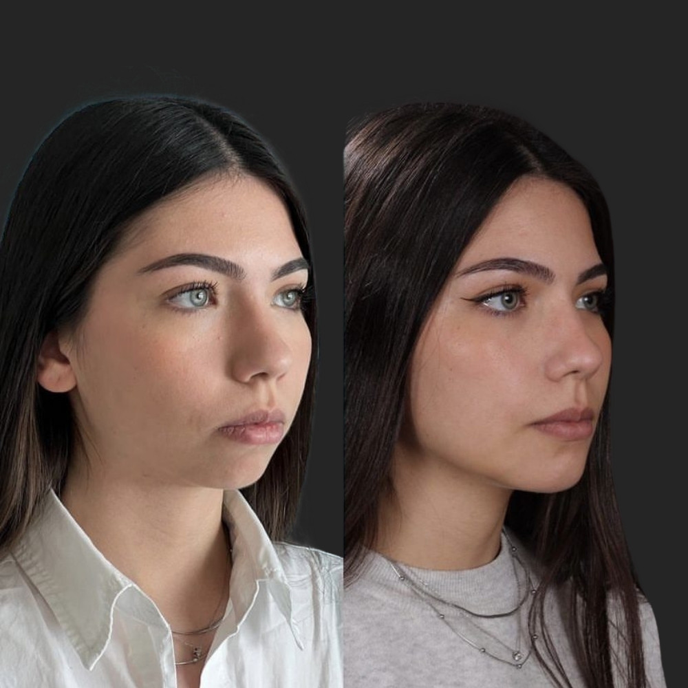 #1 (3) Facial Implants, 22 y.o., 8 days