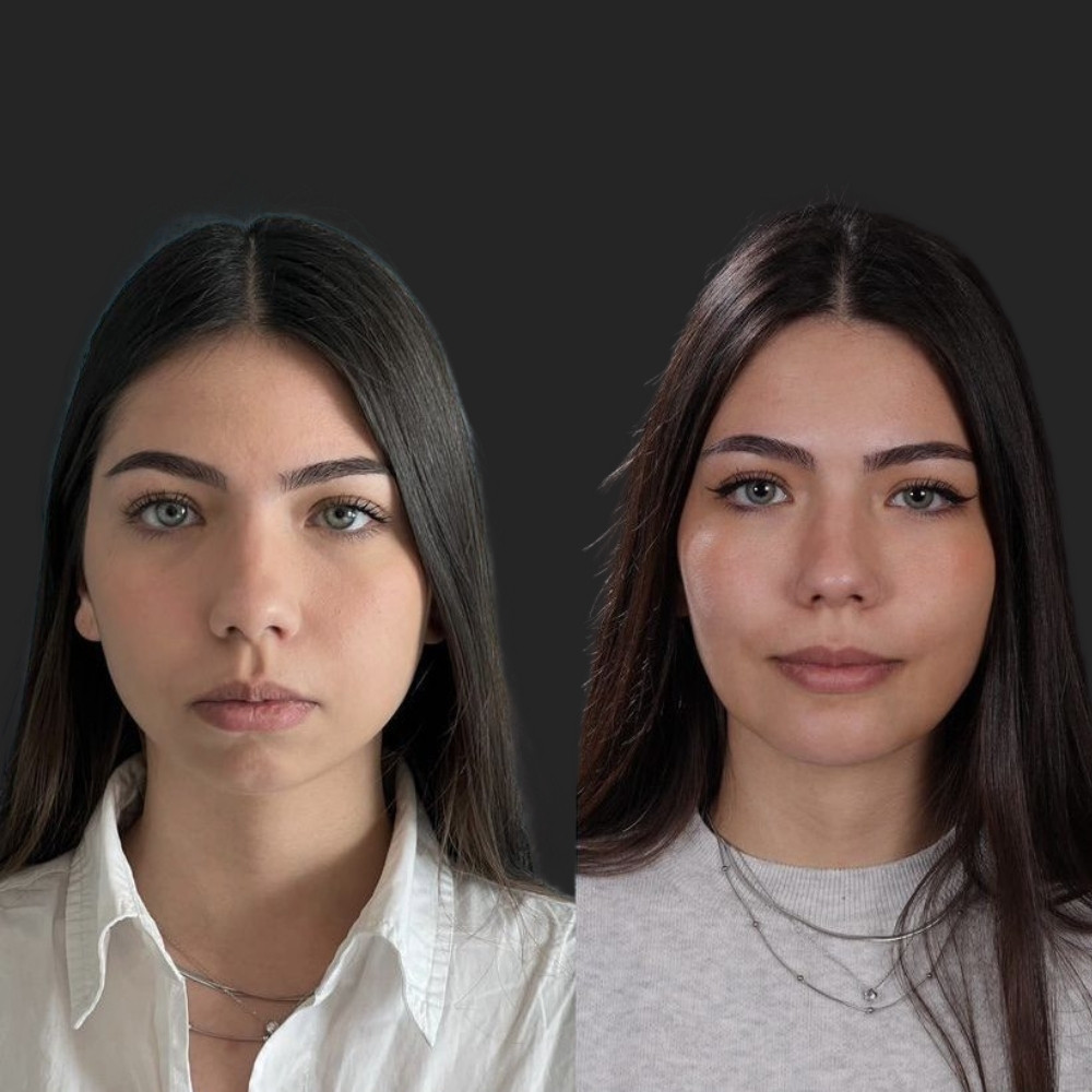 #1 (4) Facial Implants, 22 y.o., 8 days