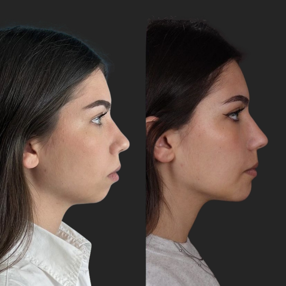 #1 (5) Facial Implants, 22 y.o., 8 days