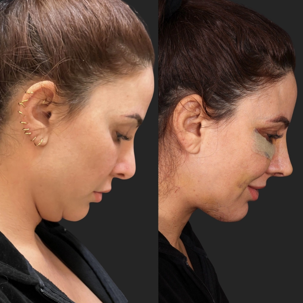 #1 Double Chin Removal, 38 y.o., 8 days