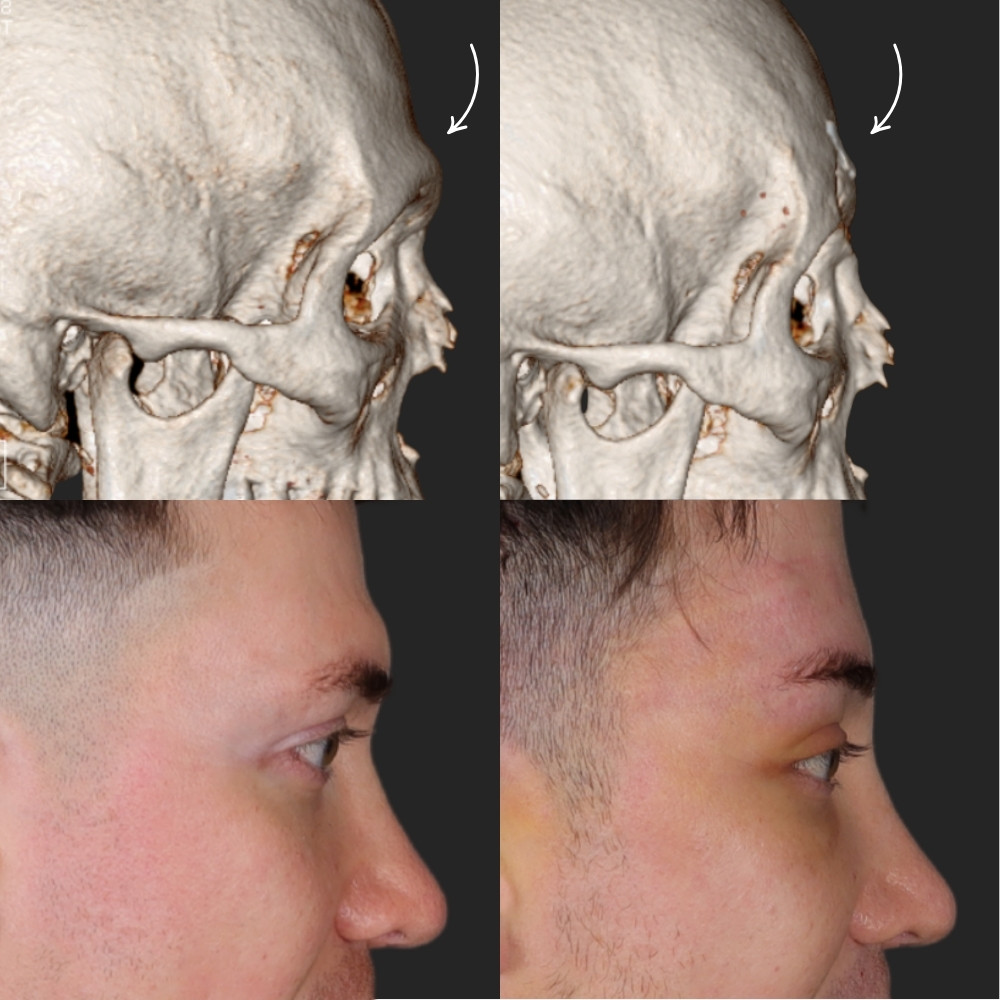 #1 Frontoplasty, 32 y.o., 5 days