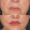 #1 Lip Lift, 67 y.o., 10 days