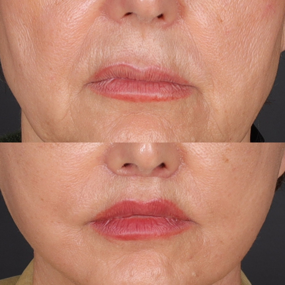 #1 Lip Lift, 67 y.o., 10 days