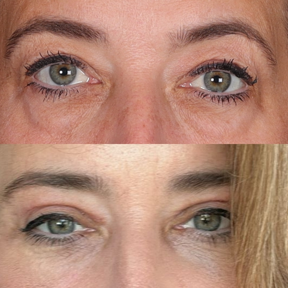 #1 Low. Eyelid, 56 y.o., 18 days