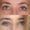 #1 Up. Eyelid, 56 y.o., 18 days