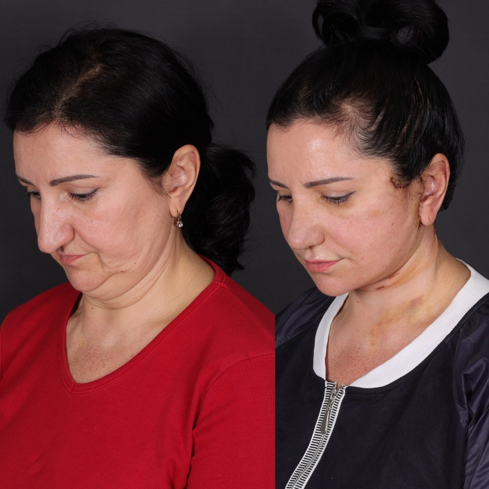 #2 (1) Double Chin Removal, 55 y.o., 10 days